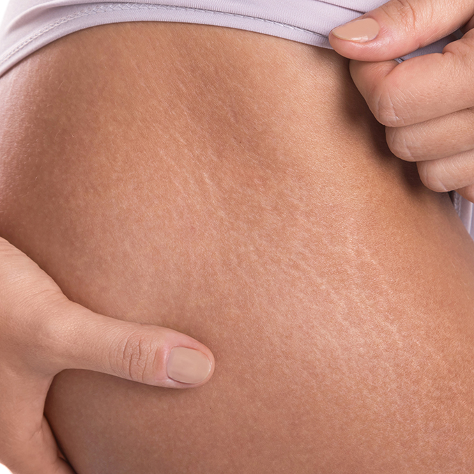 Cosa sono le smagliature